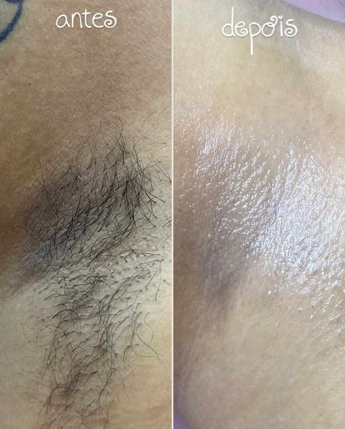 Antes e depois de depilação no Studio Femme